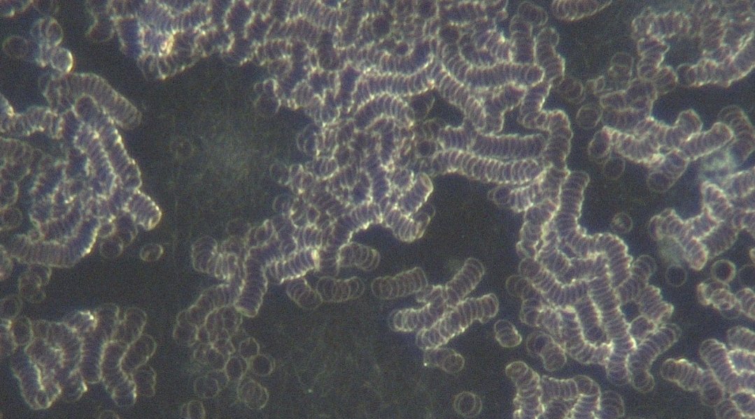 lyn_smulders's tweet photo. @Robstrat27 @holmanm I owe you a big thank you, I'd never heard of Serrapeptase before your tweet. I am convinced it's largely responsible for a massive transformation in my blood over +/- 3 months, as evidenced by live blood analysis. First 2 "before" images in June show rouleaux of RBCs 1/2 https://t.co/zyWrmMG1NI