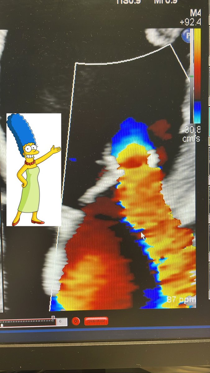 IsaMathiasMD's tweet image. You realize you are reading too many echos when you start seeing Marge Simpson on a PISA 🤷🏼‍♀️ #EchoFirst #andsecond @ASE360 @rafaelmodestoX @SLittleMD @HeartToProve