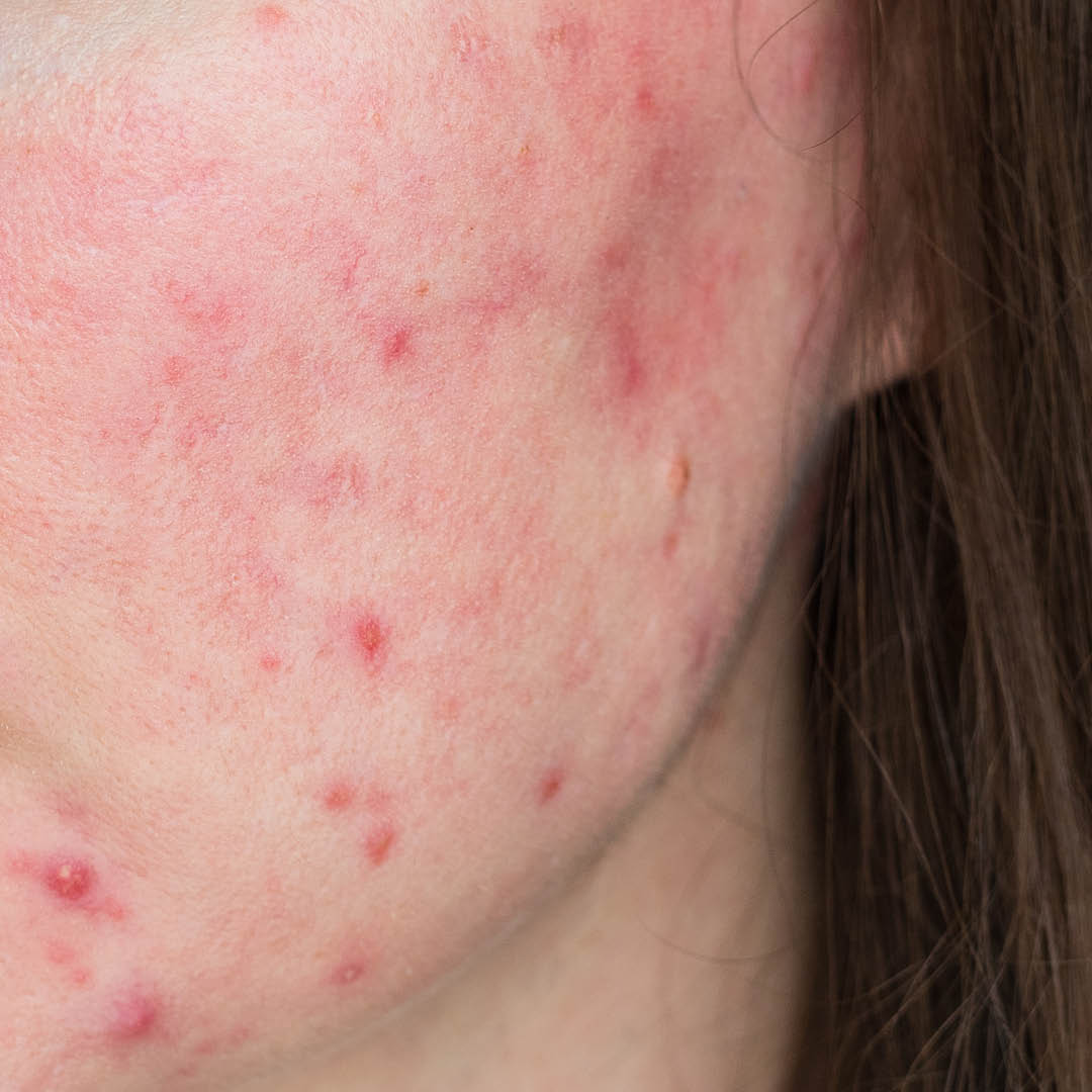 🔎Bei #Akne handelt es sich um eine entzündliche #Hauterkrankung. Spannungsgefühle, Juckreiz oder Berührungsschmerzen sind Begleiterscheinungen. Bei starken Entzündungen kann es zur Bildung von Narben kommen. Bei Verdacht auf Akne besuche eine dermatologische Praxis.