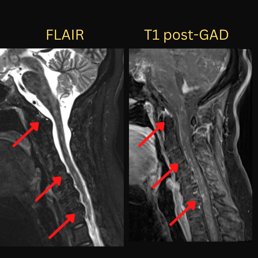 NeuroimagingN's tweet photo. Probable neurosarcoidosis
·
Involvement of the brain, spinal cord, and meninges.

#Neurosarcoidosis #probableneurosarcoidosis #neuroimaging #neurology #neurotwitter #NeuroRad #radiology #MedTwitter #MedEd https://t.co/CEvmbGeenr