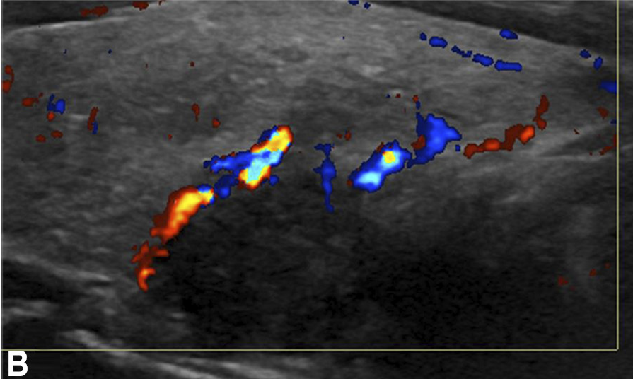 From the July-September 2022 Issue of #Neurographics: Breaking the Rules: Nonclassic Appearances of Parathyroid Adenomas ow.ly/VOhp50LnffO