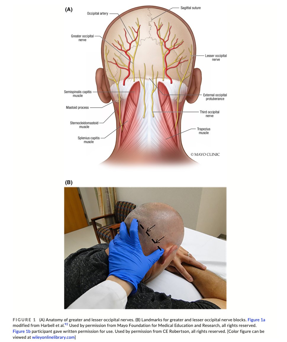 HeadacheJournal's tweet photo. Narrative review of peripheral #nerveblocks for the management of #headache 
Jennifer Stern MD, @ChiaChunChiang Narayan Kissoon MD, @BethRobertsonMD @MayoClinicNeuro 

https://t.co/pdKv6J9gAd https://t.co/QoawZ8oC28