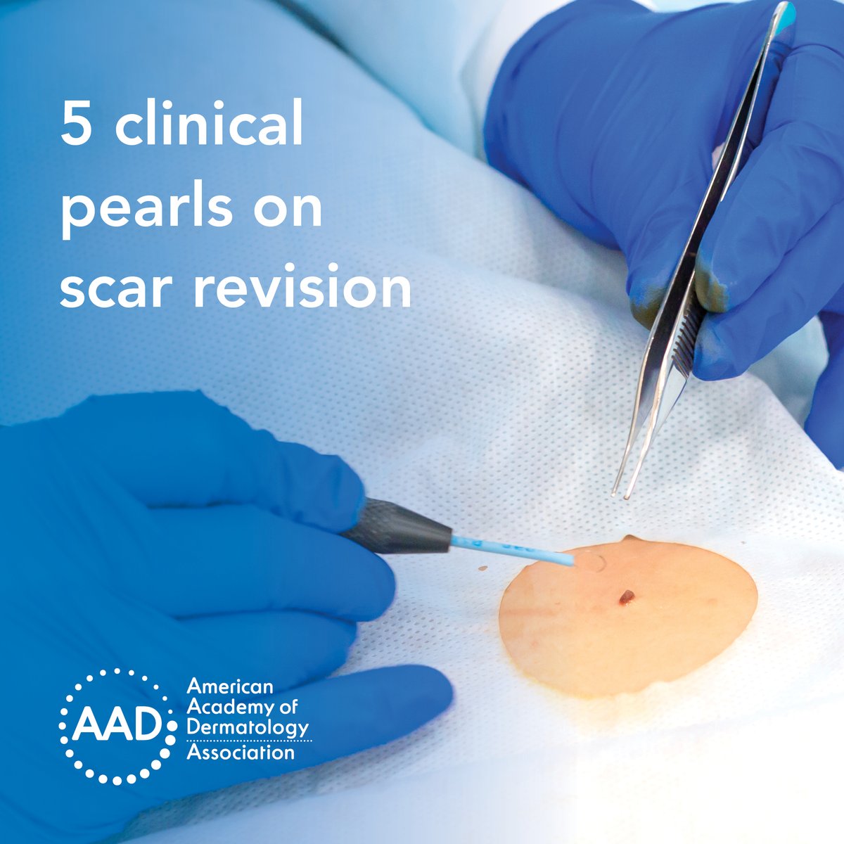 Dr. Harold Higgins provides dermatologists with 5 clinical pearls on #scarrevision in the fall issue of #DermWorld Directions in Residency. bit.ly/3RNqouU