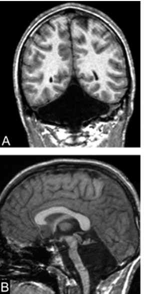 33 year old male was found on MRI to have no cerebellum. What potential symptoms or difficulties might you expect him to have? #neurology #neuroscience