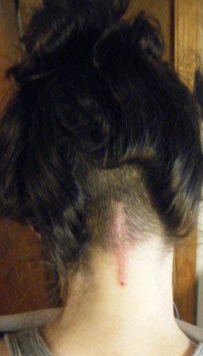 sambearrr's tweet photo. It was my 12 year brain surgery anniversary today btw. #chiari #chiariawareness #zipperhead https://t.co/a2bAE4q4Q9