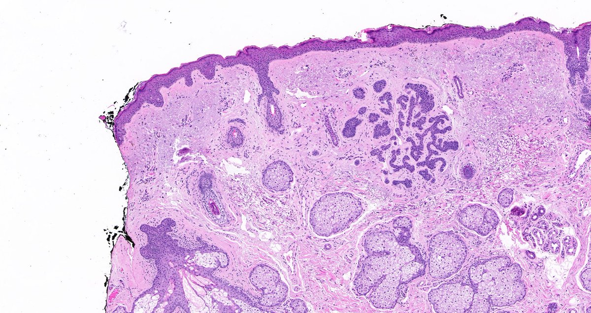 Skin, face of older patient.

2 levels

#Dermpath #pathresidents #Pathtwitter