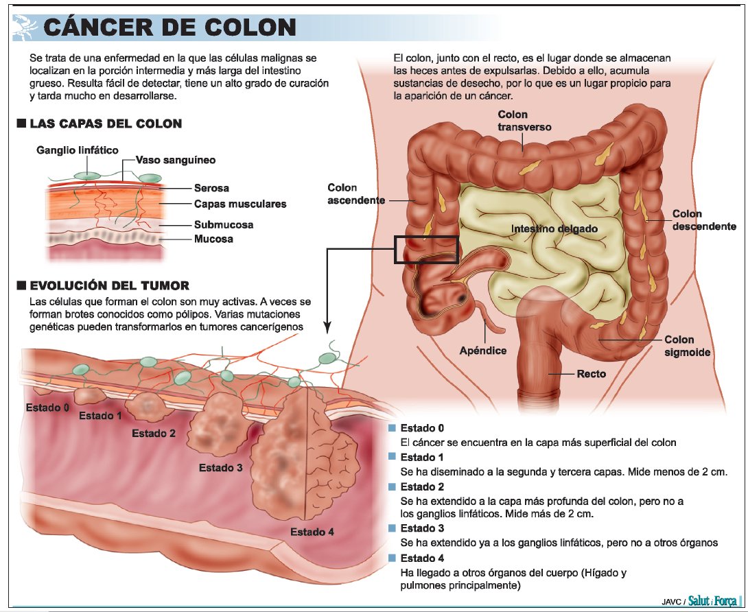 Colitis sintomas en mujeres