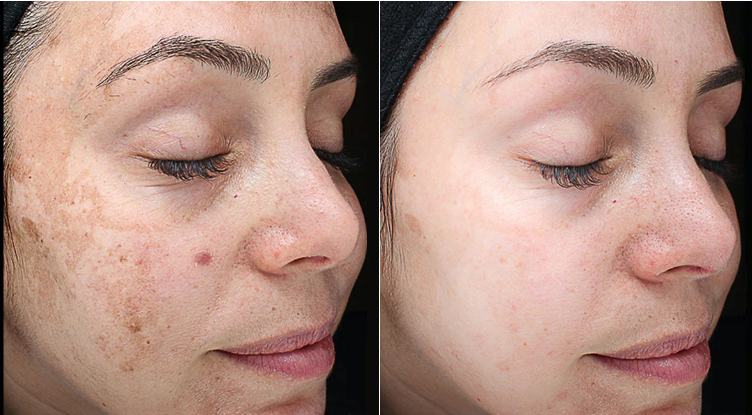 Limited Time: Enjoy $30 off a single Vi Peel (reg. price). The Vi Peel at Suddenly Slimmer Med Spa Phoenix can help reduce fine lines and wrinkles, diminish scars and sun damage, and fight hyperpigmentation suddenlyslimmer.com/vi-peel/
.
.
#suddenlyslimmer #skincare #acne #acnescars