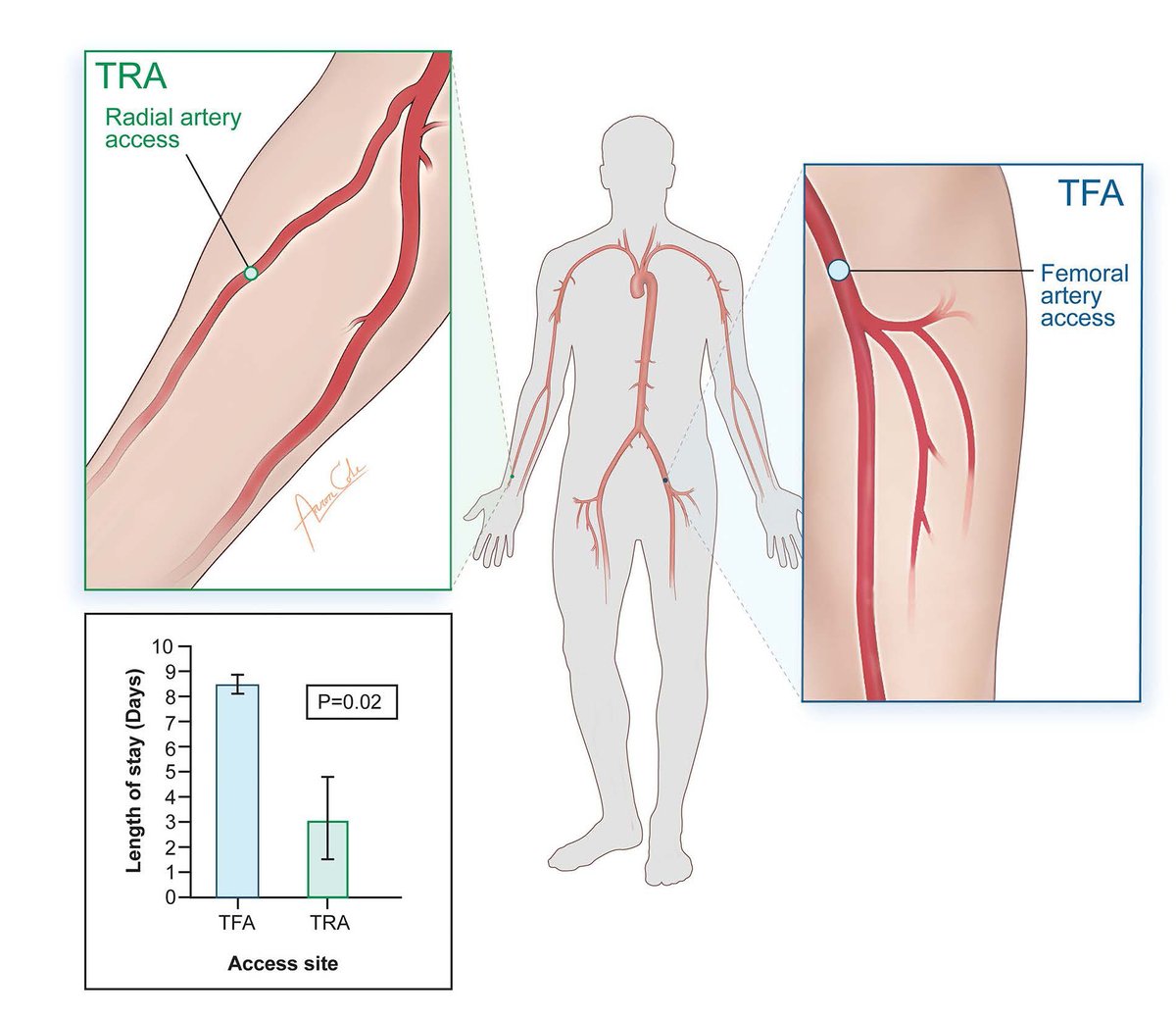 Are you team #radial or team #femoral? Points for #radial include that in EVT+tPA pts, #radial access can: ⬇️ 🏥 LOS ⬇️ complications ⬇️ hospital 💰 Check it out 🆓 ahajournals.org/doi/10.1161/SV…