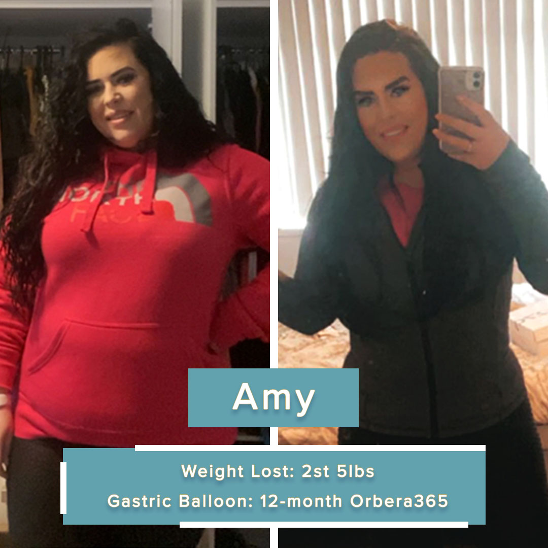 Amy's relationship with food & weight became even more difficult to handle after a car accident caused her mobility problems. With a 12-month Orbera365 balloon, she lost 2st 5lbs! 🥳 Read here: gastricballoongroup.com/gastric-balloo… #weightloss #gastricballoon #tbt