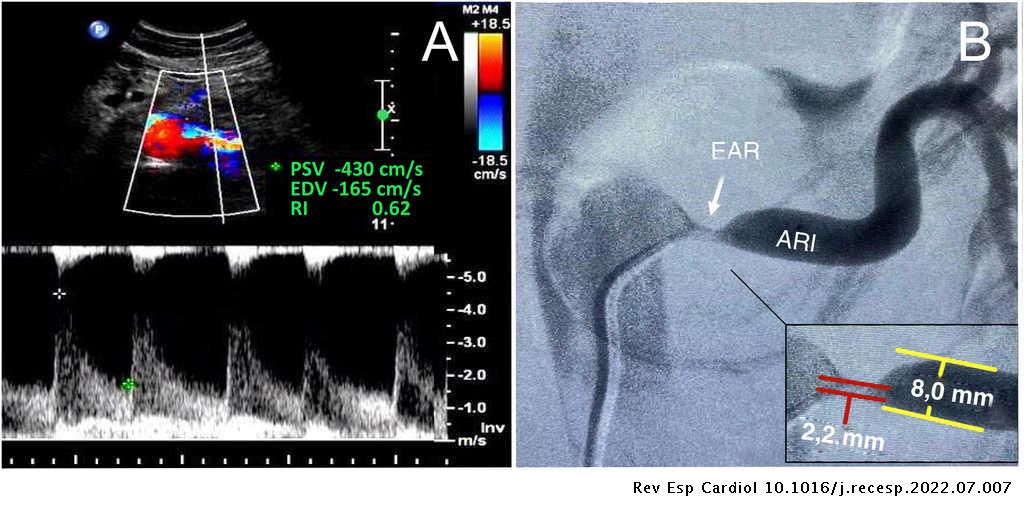 Malformación tipo lazo venoso lumbar como causa de estenosis de la arteria renal #REC #AheadOfPrint revespcardiol.org//es-malformaci…
