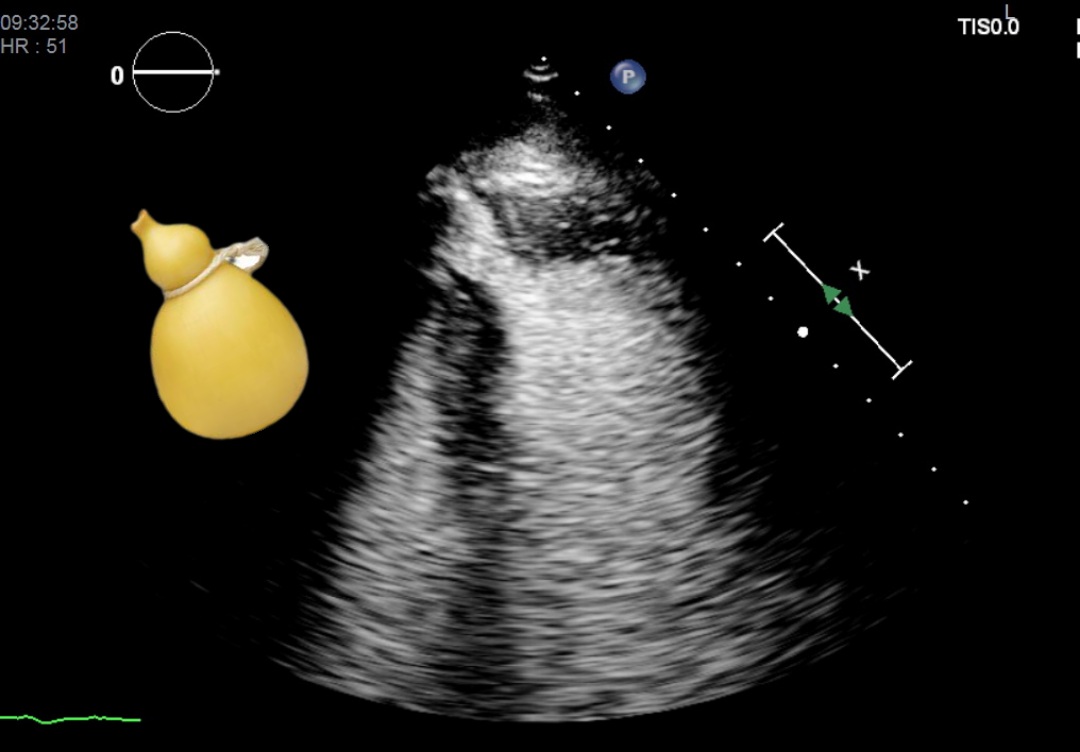 80 y/o 👵🏻 apical HCM with LV apical aneurysm and endoventricular thrombosis.
Typical contrast-echo "caciocavallo sign" 🤌🏻🇮🇹
#echofirst 
<a href="/GiuliaPassarini/">Giulia Passarini</a> <a href="/ritapavasini87/">ritapavasini</a> <a href="/ElisabettaBex/">Elisabetta Tonet</a> <a href="/davide_lapolla/">Davide Lapolla</a> <a href="/BeatriceCarolis/">Beatrice De Carolis</a> <a href="/Feff93/">Federico Marchini</a>