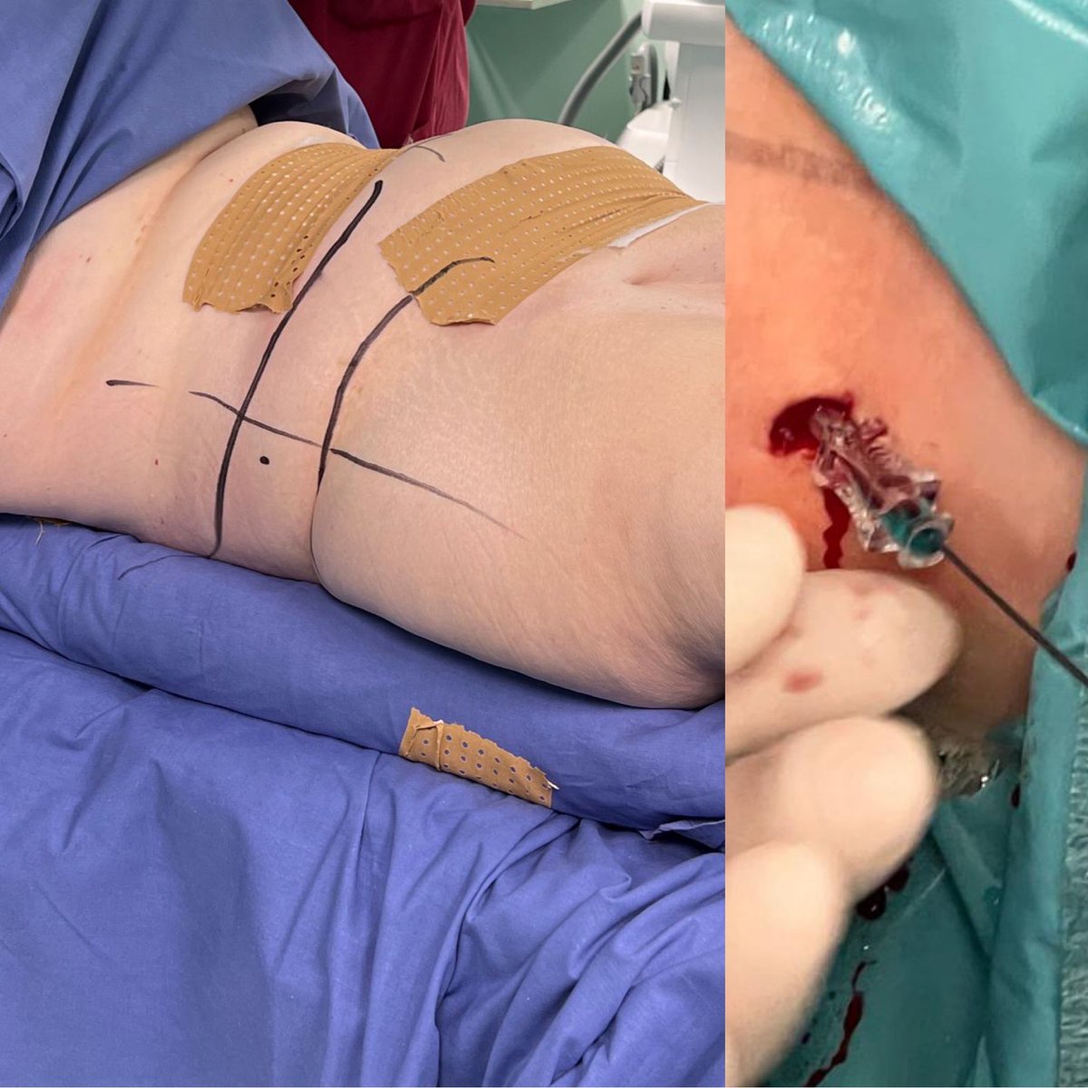 GuidoGiusti's tweet photo. Sometimes also in #Milan we have to deal with morbidly obese patients BMI 46 & #supinePCNL: all needle was in!😳 displace the fatty cover laterally with tape preop & have longer #Amplatz sheaths 24cm available! #ETCE https://t.co/Z2fiJmYtti