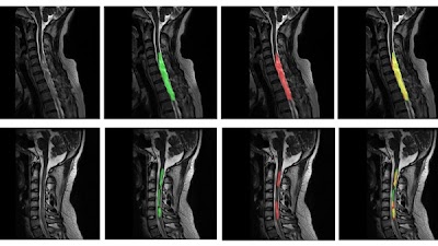 Automated Classification of Intramedullary Spinal Cord Tumors and Inflammatory Demyelinating Lesions Using Deep Learning doi.org/10.1148/ryai.2… @TJMU_China @unige_en @Health_Eng #DeepLearning #demyelination #AI