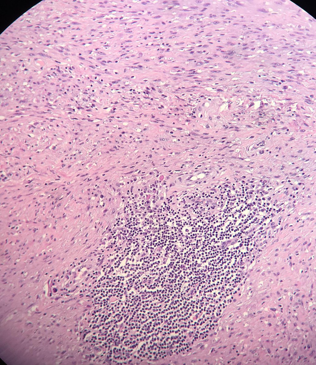 Fernand85859909's tweet photo. 19-year-old woman with a 5 cm vulvar tumor. Actin, desmin, caldesmone, ER,PR, stat6, S100, CD31, beta catenine (all negative) CD34&amp; CD68+. Any idea gyn and soft tissue paths? Gracias:)  @histiocytosisX  @crisdelarco  @david_marcilla @JMGardnerMD @LizMontgomeryMD @AnneMillsMD https://t.co/45LjbVJR4V
