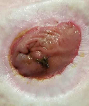 52F with Crohn's A/W bleeding from her ileostomy requiring 9 units of blood. OGD, ileoscopy, CT and capsule ALL normal. Re-examination found an ulcer + visible vessel which stopped with a suture🧵 Case report is entitled: 'Stitch in time saves nine' 😅👏 fg.bmj.com/content/early/…