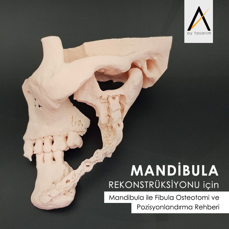 aytasarim's tweet photo. Mandibula Rekonstrüksiyonu için Mandibula ile Fibula Osteotomi ve Pozisyonlandırma Rehberi 🎈 https://t.co/N9g5w40zA2