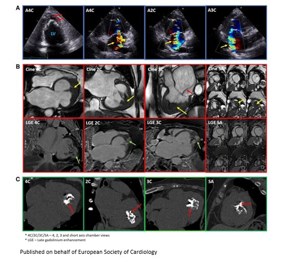 ESC_Journals's tweet image. Severe mitral regurgitation in a patient with left-ventricular endomyocardial fibrosis: a challenging case academic.oup.com/ehjcr/article/…

#EHJCaseReports @aayshacader @ANazmiCalik @KardiologieHH  @EHJCREiC @TJ_Yeo @cfcamm @FarhanaAra #YesCCT #EchoFirst #ImageFirst #wyhCMR