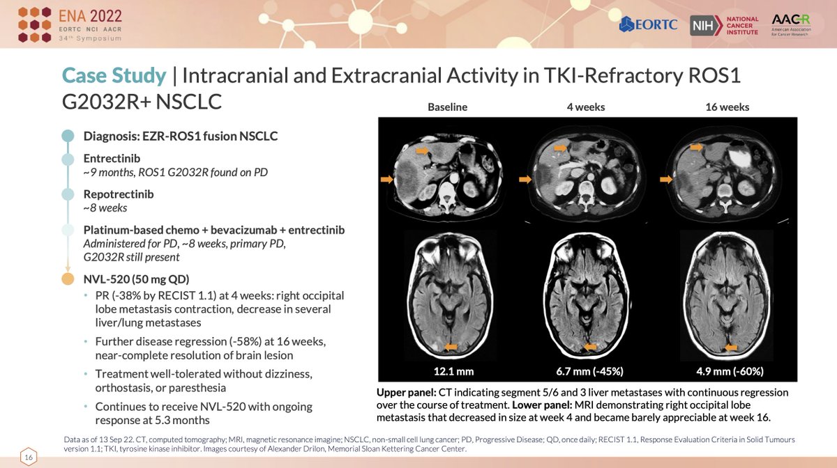 Important to retain CNS efficacy and NVL-520 showing intracranial activity in refractory settings. Very promising #ROS1 inhibitor going forward. Congratulations to authors. Excited to now have this trial open at @Georgetown @LombardiCancer #LCSM #ENA2022