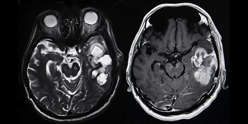 Read this week's Cancer Discovery #ResearchWatch: 19F MRI Enables Monitoring of Tumor-Associated Macrophages in Cancer, a summary of the paper by @davide_croci, @Johanna_A_Joyce et al. bit.ly/3DkqzIO @Joycelab @unil @Ludwig_Cancer