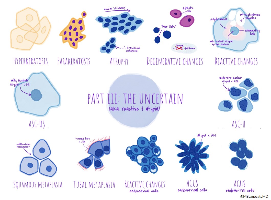 MELanocyteMD's tweet photo. Looking back on residency, I regret not doing more #pathart projects...

Hopefully I can do more in the future, but for now enjoy the re-release of my Cervical Cytology Series! 👩🏼‍🎨🖼️

Now available as printable "wallhangers": 
➡️ https://t.co/urS5gAm8hD ⬅️

#cytopath #gynpath https://t.co/IYmFi3ZTIl