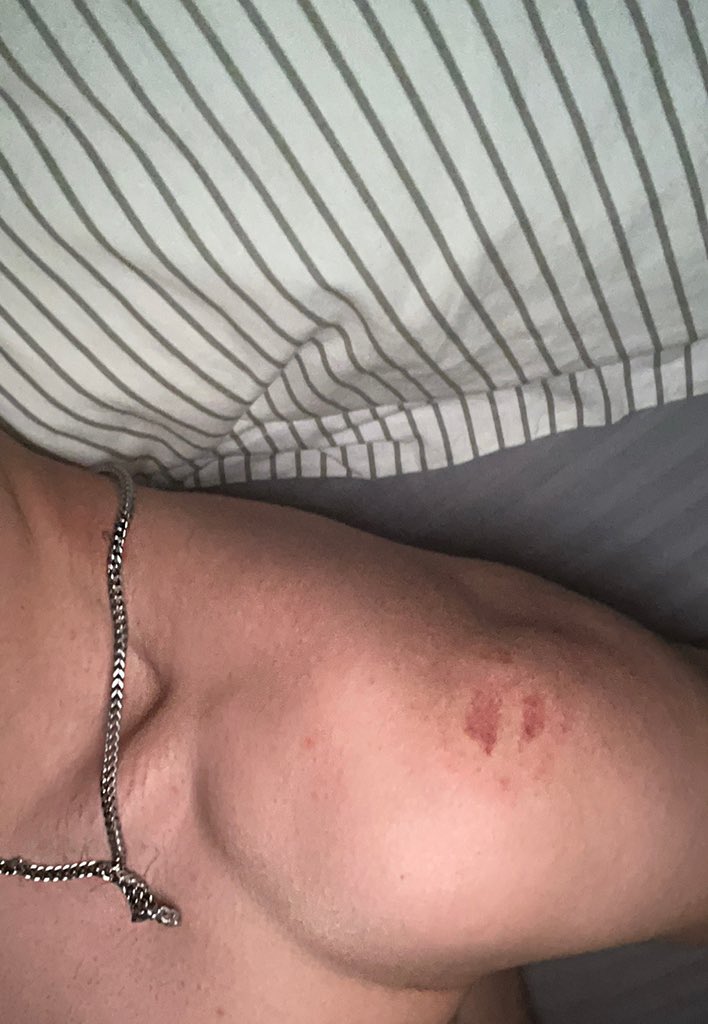 iliajaniiii's tweet photo. نه،ب��تون و ساچمه نخوردم باورش سخته ولی یه جوجه بسیجی کتف مو گاز گرفته.
#مهسا_امينی‌ https://t.co/L1hD0bG5OR