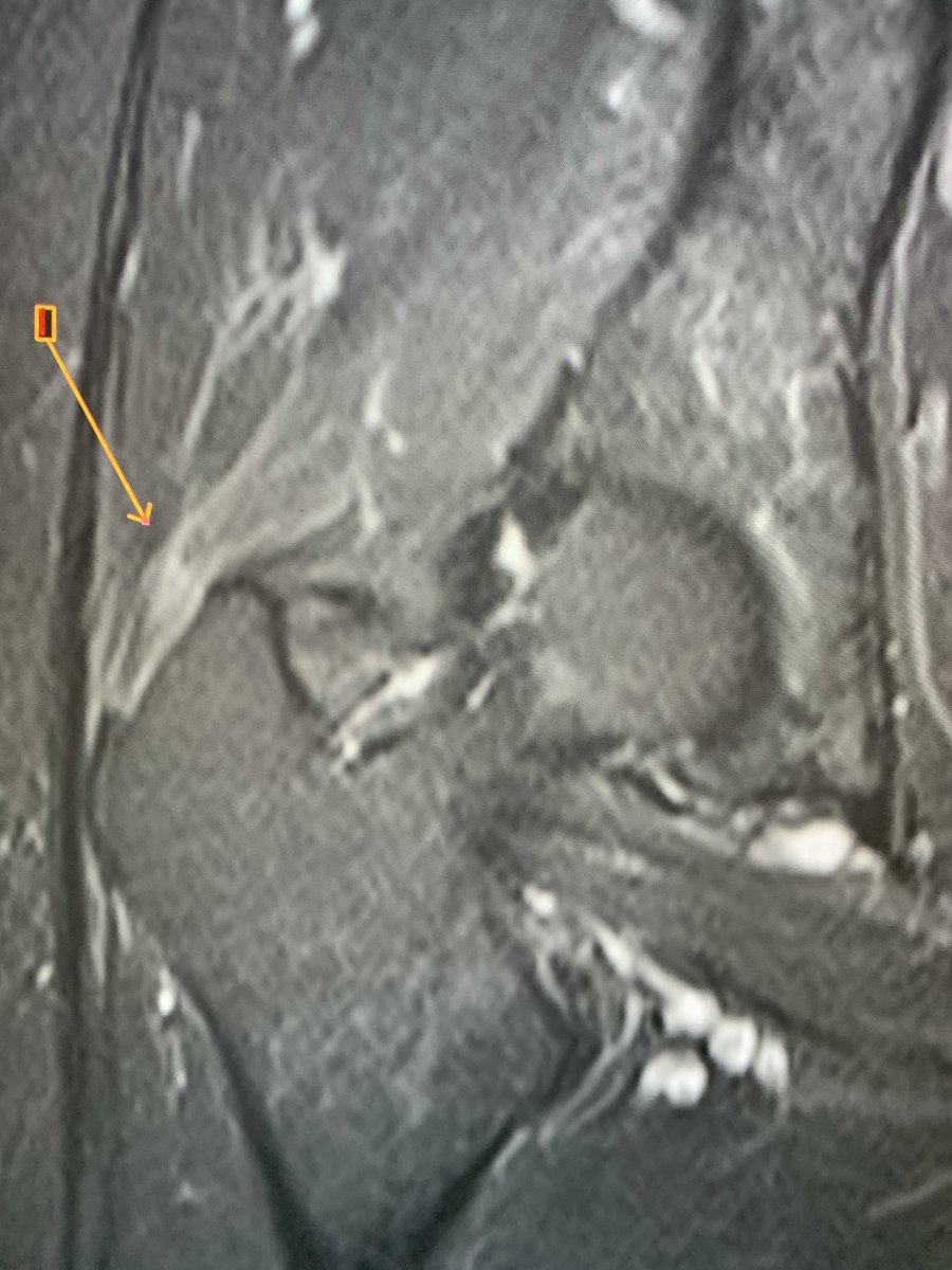 northwoods1980's tweet photo. All of these middle aged patients still coming through orders with “trochanteric bursitis“. Just stop it. You know it’s usually anterior gluteal medius chronic avulsive tears right!😩.  It’s hardly ever bursitis https://t.co/IWMSASNJHQ
