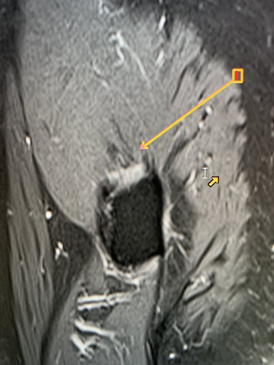 northwoods1980's tweet photo. All of these middle aged patients still coming through orders with “trochanteric bursitis“. Just stop it. You know it’s usually anterior gluteal medius chronic avulsive tears right!😩.  It’s hardly ever bursitis https://t.co/IWMSASNJHQ