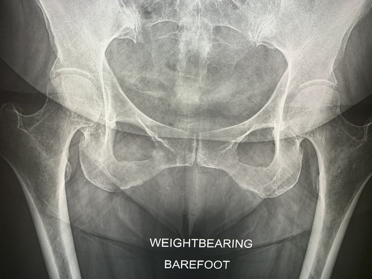 All of these middle aged patients still coming through orders with “trochanteric bursitis“. Just stop it. You know it’s usually anterior gluteal medius chronic avulsive tears right!😩.  It’s hardly ever bursitis