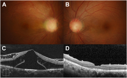 OCT of papillorenal syndrome associated with PAX2 mutation showing retinoschsis, foveal detachment with outer macular hole. After vitrectomy with gas tamponade, the retina was reattached and VA improved from 20/200 to 20/63. ow.ly/RTb050L2yT3