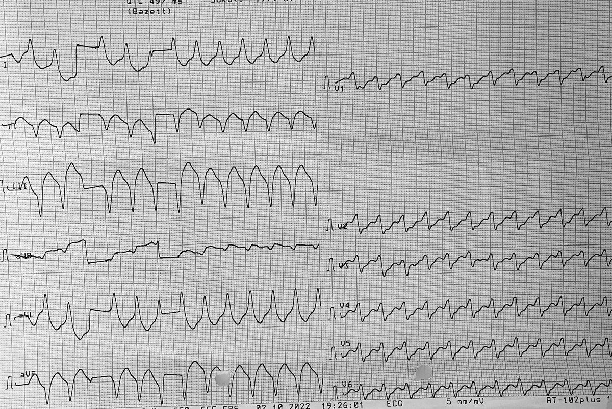 Kamil Gülşen (@kamilgulsen) on Twitter photo 42 yo male without structural heart disease has fraquent ICD shocks. What do you think about localisation of arrythmia <a href="/drserdardemir/">Doç Dr Serdar Demir</a> <a href="/alperkepez78/">Alper Kepez</a> <a href="/javadm20/">javad mikaeili</a> <a href="/drabdlkdruslu/">Abdulkadir Uslu</a> <a href="/DursunAras2/">Dursun Aras, Professor</a> <a href="/YalinKivanc/">Kıvanç YALIN</a> <a href="/ftrae/">Piotr Futyma, MD</a> <a href="/taylanakgun/">Taylan Akgün</a> @drerkanbaysal <a href="/Sabri_Demircan/">Sabri Demircan</a> <a href="/hikmetyorgun/">Hikmet Yorgun</a> 42 yo male without structural heart disease has fraquent ICD shocks. What do you think about localisation of arrythmia <a href="/drserdardemir/">Doç Dr Serdar Demir</a> <a href="/alperkepez78/">Alper Kepez</a> <a href="/javadm20/">javad mikaeili</a> <a href="/drabdlkdruslu/">Abdulkadir Uslu</a> <a href="/DursunAras2/">Dursun Aras, Professor</a> <a href="/YalinKivanc/">Kıvanç YALIN</a> <a href="/ftrae/">Piotr Futyma, MD</a> <a href="/taylanakgun/">Taylan Akgün</a> @drerkanbaysal <a href="/Sabri_Demircan/">Sabri Demircan</a> <a href="/hikmetyorgun/">Hikmet Yorgun</a>
