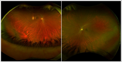 A subset of retinal detachments may be managed with initial non-surgical management in select asymptomatic patients. ow.ly/xRO950LbeTk