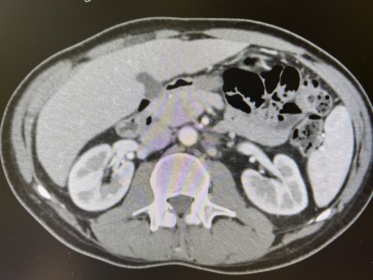 Very important and timely topic. Just one case of ours to challenge your guidelines: 25yo, testicular ECA, intermediate prognosis for HCG >5K, retroperitoneal mass the only site. BEPx4 > major response STM negative. RPLND or Surveillance? @SpiessPhilippe @GTumors @DanieleRaggi83
