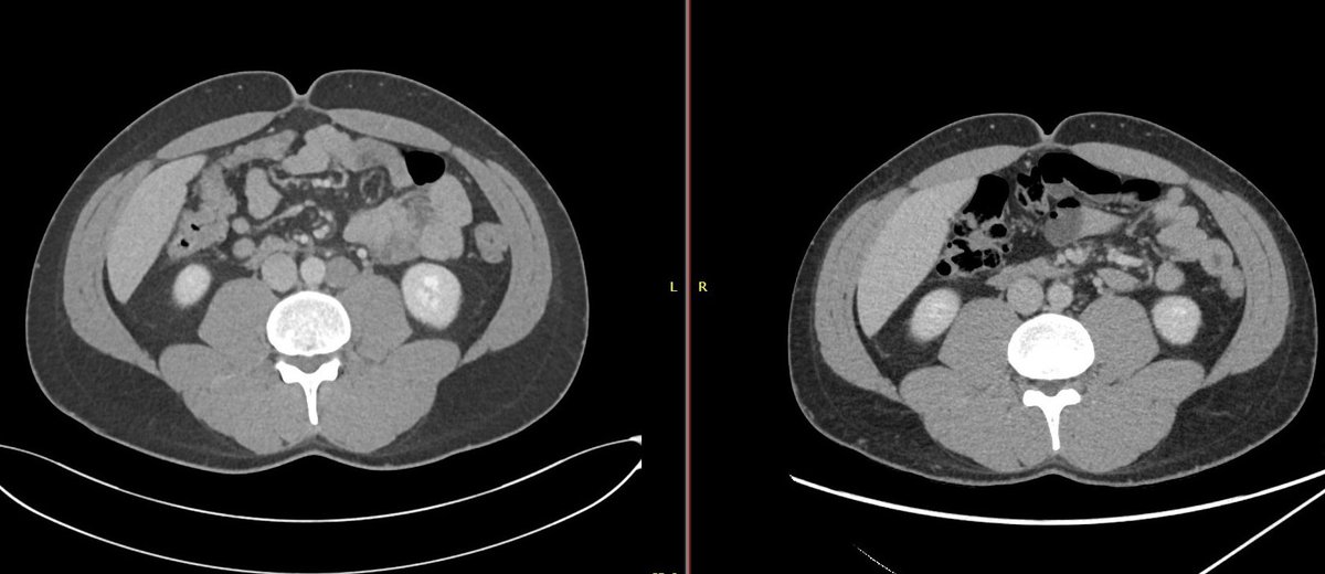 Another situation I feel very critical: CSI nonseminoma, high risk. Right side baseline CT scan vs repeat CT scan (left) post 2 months prior to decide what to do. Should we revise the initial timing of image assessment in CSI? @GTumors @SpiessPhilippe @RHamiltonUrol