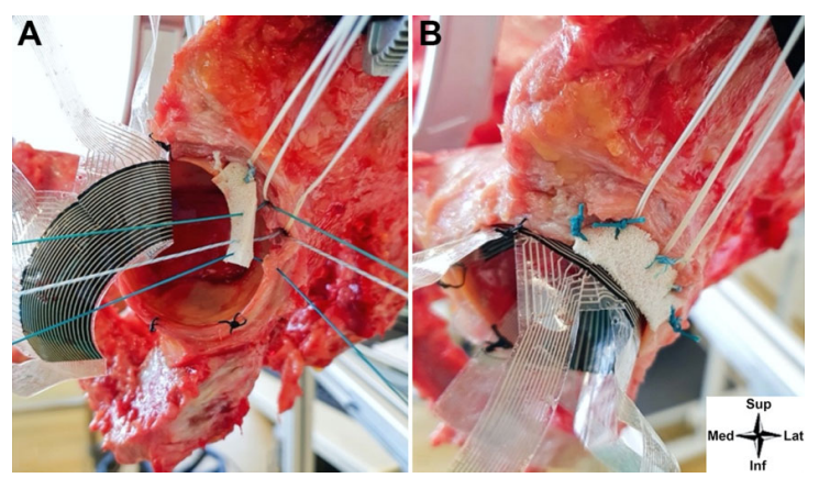 OJSM_SportsMed's tweet photo. Hip #labralreconstruction after partial labrectomy using a synthetic polyurethane scaffold improved hip joint kinetics and restored hip labrum suction seal in most specimens #hiparthroscopy #biomechanics #FAI #hipsurgery @DrBrunoCapurro https://t.co/LsJf2bIhEZ https://t.co/didIoJpODC