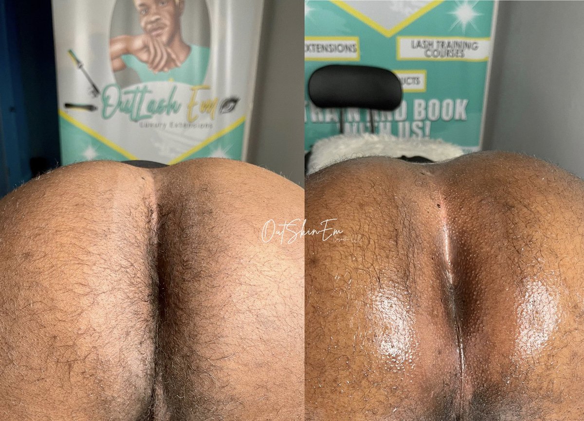 therealttc_'s tweet photo. #AnalWaxing🍑 @atlfun2 ✨ 
In addition to removing excess, unwanted hair, waxing also removes the top layer of dry, dead skin cells. FRESH NEW SKIN🙌🏽 https://t.co/p3L05naWvL
