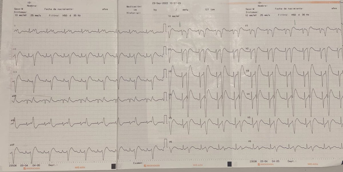 Un seguidor nos ha hecho llegar este maravilloso y terrorífico ECG 👻🧌👽🧛🏽 ideal para comentar en este fin de semana de #Halloween 🎃 ¿Qué os parece? Muchas gracias por enviárnoslo, @miguelsilvac10