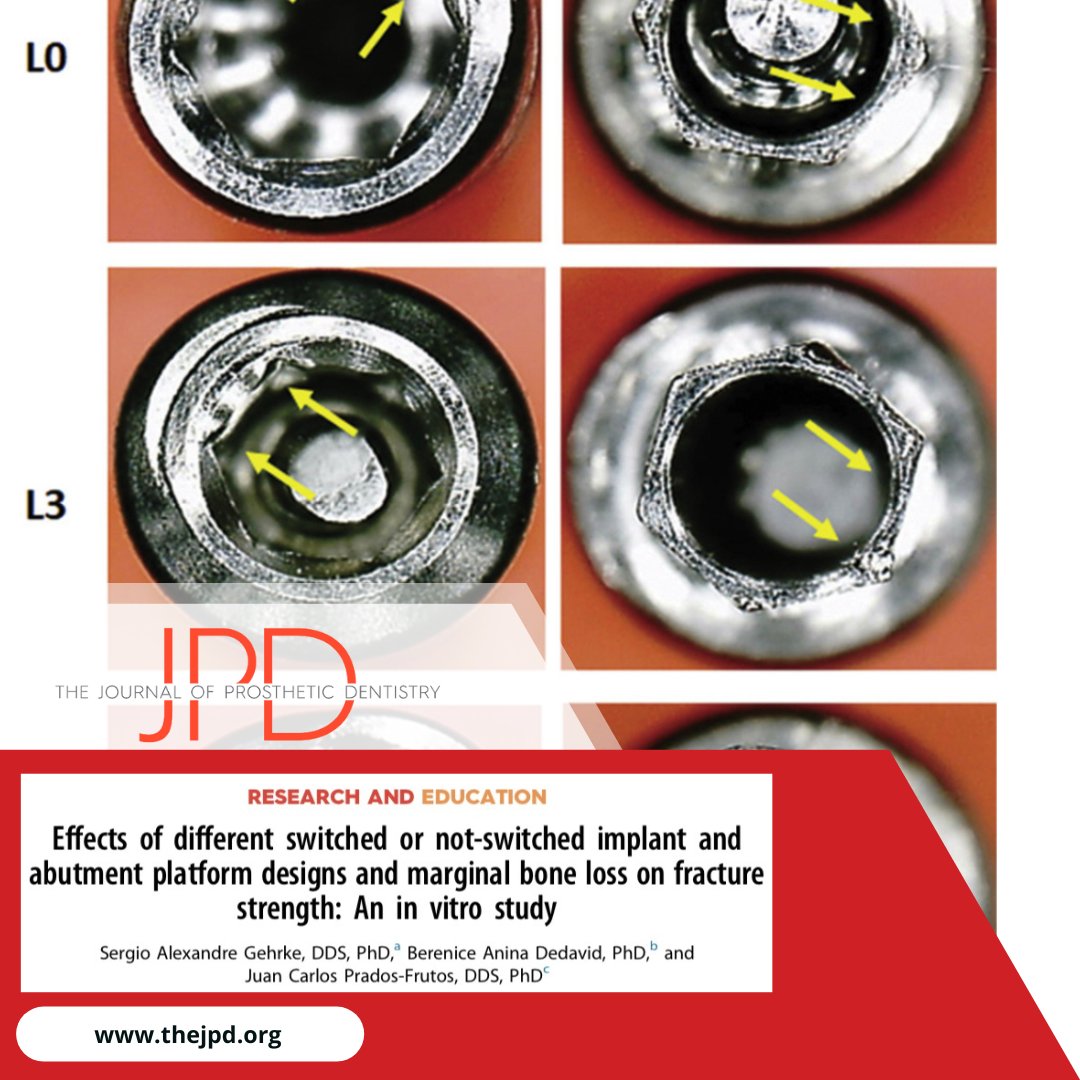 JPDentistry's tweet photo. This #invitro study from #theJPD analyzes the maximum fracture strength of #abutments and 
#implants with #platformswitch based on different diameters and insertion torques. Learn more: https://t.co/Jg3x6noXHz https://t.co/i66CSOk2Wy