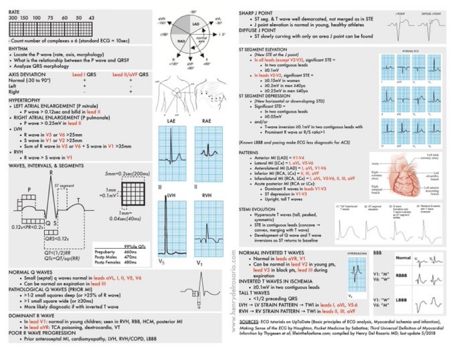 EKG interpretation cheat sheet by Dr. Henry Del Rosario #MedEd #MedTwitter