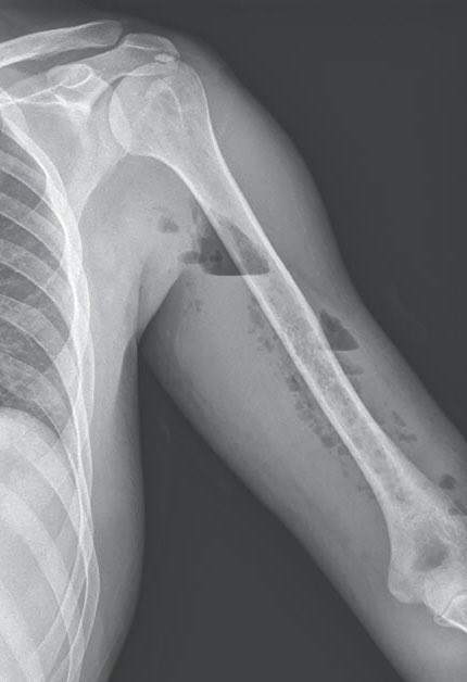OGdukeneurosurg's tweet photo. Patient had blunt trauma a week ago now with pain and swelling. Don’t miss this serious finding on X-ray, please! https://t.co/AoTVoyveh3