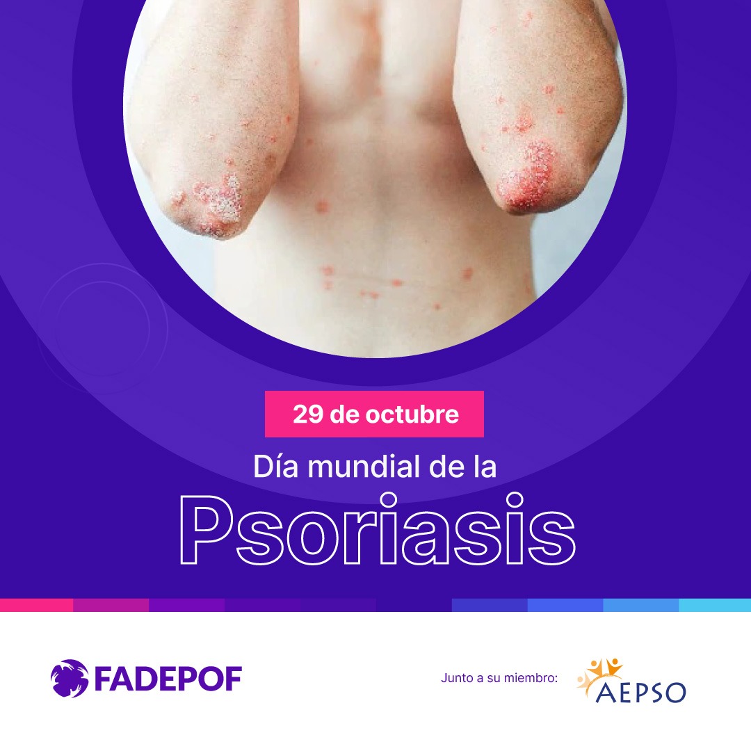 Dentro de esta enfermedad encontramos dos tipos la Artritis Psoriásica y la Psoriasis Pustulosa Generalizada que por su baja prevalencia son consideradas Enfermedades Poco Frecuentes.
#psoriasis
#psoriasisdiet
#psoriasiswarrior