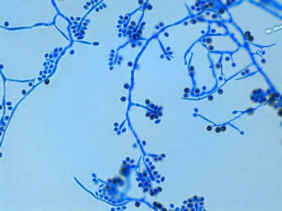 koshurambur's tweet image. Sporotrichosis (also known as “rose gardener&apos;s disease”) is an infection caused by a fungus called Sporothrix. This fungus lives throughout the world in soil and on plant matter such as sphagnum moss, rose bushes, and hay.
#MedTwitter #Medical