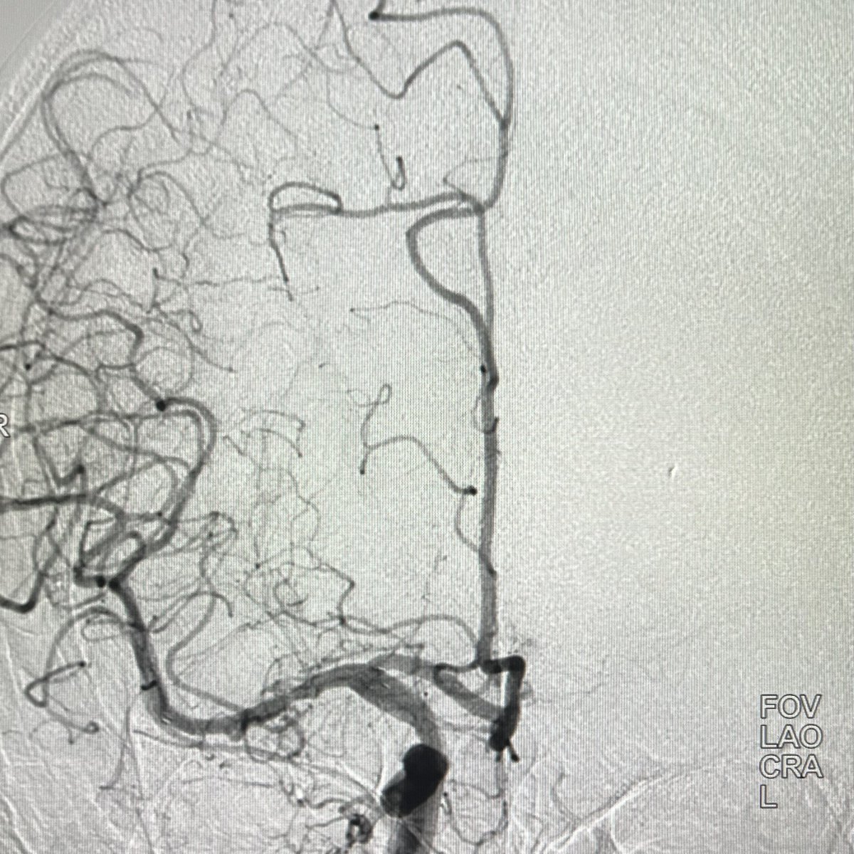 daigaole's tweet photo. Carefully selected ICAS cases,
Stenting is still an option. https://t.co/1JPkWOvDJA