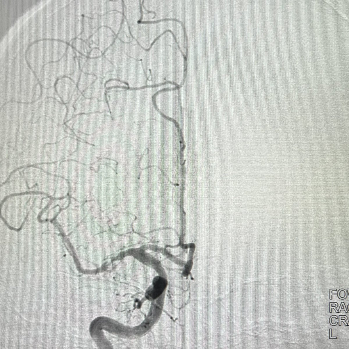 daigaole's tweet photo. Carefully selected ICAS cases,
Stenting is still an option. https://t.co/1JPkWOvDJA