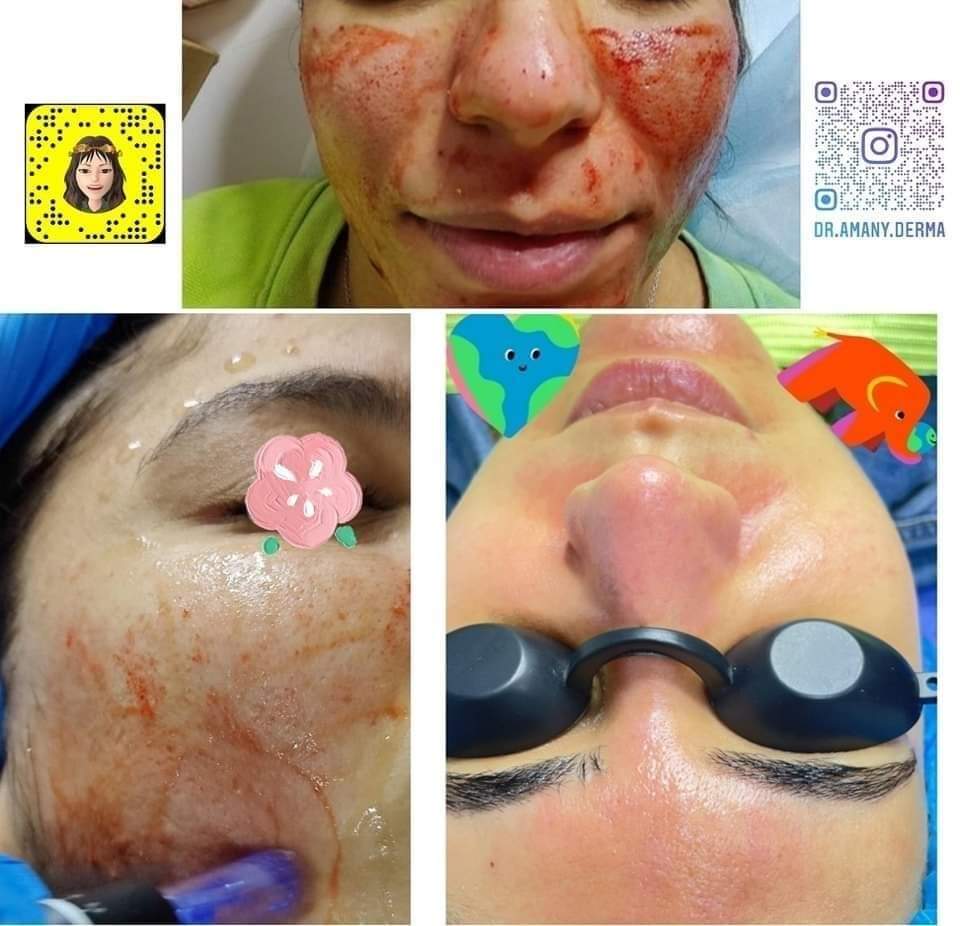 Dramanyderma's tweet photo. 🌸 الباقة ال��لكية vip 👑

(تنظيف ملكيvip  بمواد اسبانية و إيطالية أصلية + جلسة ديرمابن بالبلازما + جلسة ديرمابن بميزو التفتيح + جلسة ديرمابن بميزو التوريد + تقشير ماسي للرقبة ) 
250 دينار بدل 450 لفترة محدودة 💵🔥 https://t.co/h09PatJzBf