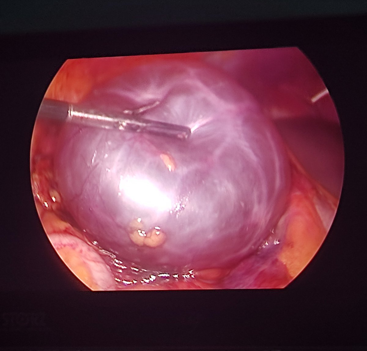 Helmovich's tweet photo. A 47 years female, with right flank pain, CT scan showed: a 10 cm kidney cyst BOSNIAK II lower pole.
Trans peritoneal laparoscopic dissection.
#urology #endourology #laparoscopy #coelio #kidney #cyst #resident https://t.co/MW8xT2uR64