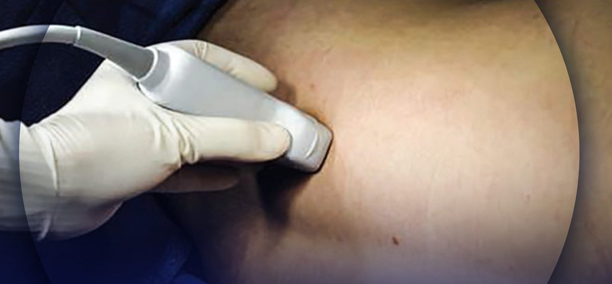 NYSORA's tweet photo. How to increase needle precision during #LumbarPlexusBlock (#LPB) in the real operating room environment? Find the answer here: https://t.co/Iz1CagajxZ https://t.co/EpHworvRIJ