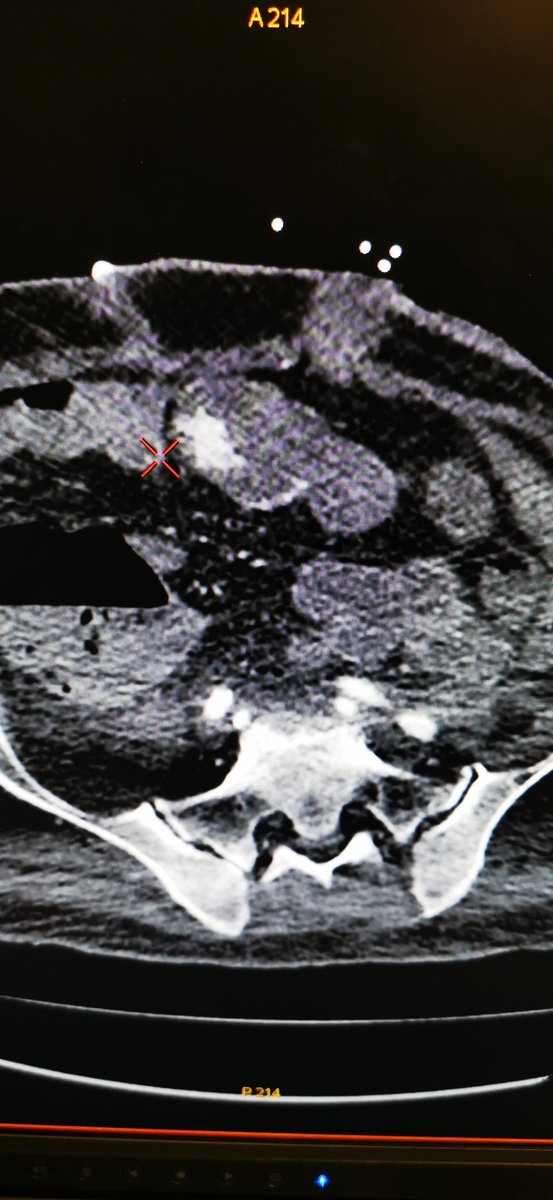DrPoullosN's tweet photo. The case was performed in the interventional radiology sector of Nicosia General Hospital 🇨🇾. The interventional radiology can save lifes 👌 
 #cyprus #shso #embolisation #ΟΚΥπΥ #ΓεΣΥ #Nicosia #hospital #interventionalradiology #MoH https://t.co/NPCpCfnAwC