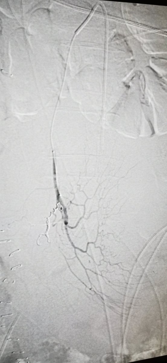 DrPoullosN's tweet photo. The case was performed in the interventional radiology sector of Nicosia General Hospital 🇨🇾. The interventional radiology can save lifes 👌 
 #cyprus #shso #embolisation #ΟΚΥπΥ #ΓεΣΥ #Nicosia #hospital #interventionalradiology #MoH https://t.co/NPCpCfnAwC