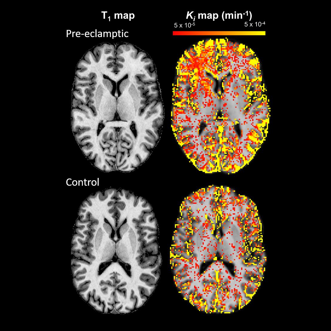 Maternal blood–brain barrier is impaired years after pre-eclampsia, shows #freeaccess MRI study by Canjels et al. published in the October #UOGJournal issue bit.ly/3VR0HNs #ISUOG @WileyHealth